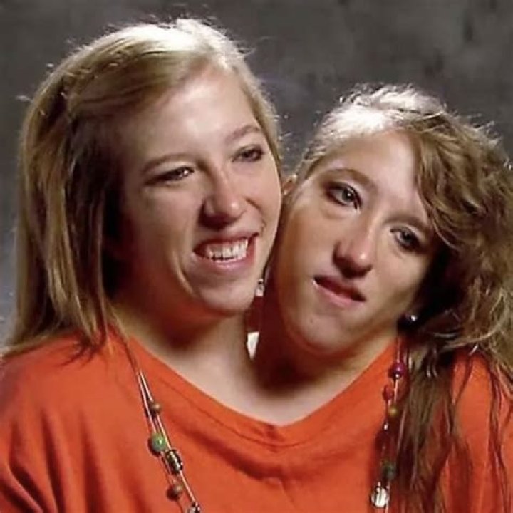 Conjoined Twins Abby and Brittany: Sad News and Their Remarkable Journey