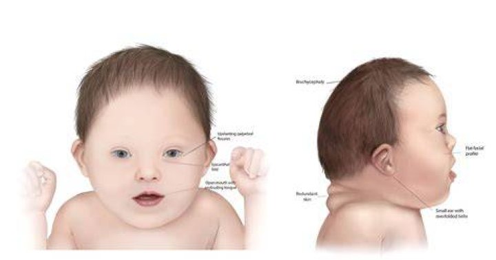 Does Simon Cowell's Son Have Down Syndrome? Understanding the Facts and Myths