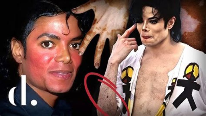 Michael Jackson's Battle with Vitiligo: Understanding the Truth Behind His Skin Condition
