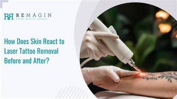 Tattoo Before SurgeryRisks, Benefits, And Expert Advice