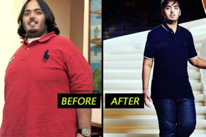 Transformative Journey: Anant Ambani's Weight Loss Surgery