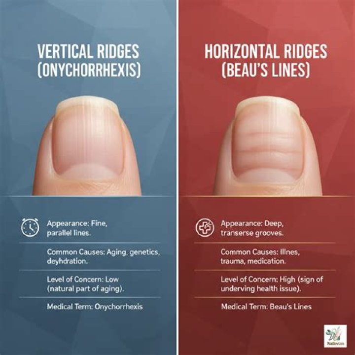 Understanding and Addressing Vertical Ridges on Nails