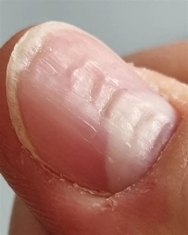 Understanding Fingernail Ridges and Their Connection to Vitamin Deficiencies
